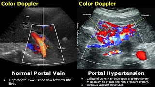 Portal Vein Color amp Spectral Doppler Ultrasound Normal Vs Abnormal Images  Liver Vascular USG Scan [upl. by Burke]