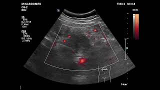 unmatching sono amp CT on pancreas [upl. by Reldnahc]