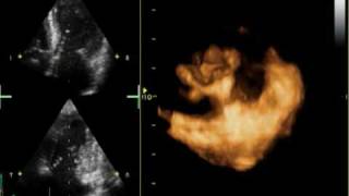 3D MITRAL REGURGITATION PROLAPSE P2 AND P3 [upl. by Rap854]