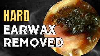 SOLID Hard Earwax Removed After Weeks [upl. by Ayenat]