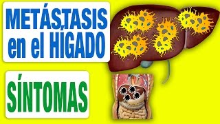 Todos los Síntomas de las Metástasis en el Hígado [upl. by Tufts]