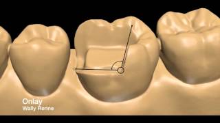 Posterior tooth preparations inlay onlay crownlay and crown [upl. by Leunam340]