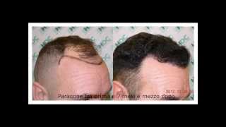 Trapianto di capelli FUE 3050 grafts [upl. by Ardnahsal]