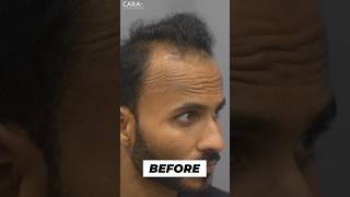 Receding Hairline Transplant Results  Sapphire Hair Transplant Results Before amp After [upl. by Joan]