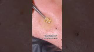 Extracción de Espinillas y Comedones acne facial rostro [upl. by Eceinhoj]