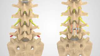 ILIF  Patient Animation [upl. by Elbys878]