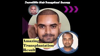 Hair Transplant Result after 1 month  Unrealistic hairline and density  Day 0 to Day 30 [upl. by Ellenhoj]