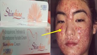 Skin Shine CREAM SIDE EFFECTS के कारण  Reason of SIDE EFFECTS  How to Remove side effects  Hindi [upl. by Hgieliak]