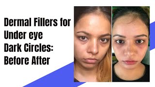 Dermal Fillers in Delhi  Face filler before and after Undereye filler Undereye circle treatment [upl. by Selima]