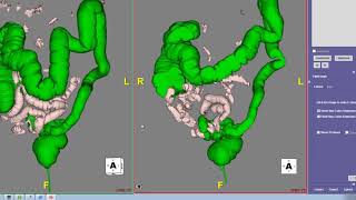 CT Colonography [upl. by Nibla]