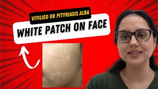 White patch on face Is this Vitiligo or Pityriasis alba II Dr Surbhi MD [upl. by Neleb]