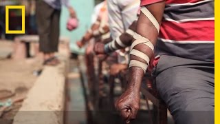 WATCH The Practice of Bloodletting in New Delhi  National Geographic [upl. by Beauregard]