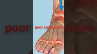 The shocking cause of ankle swelling  causes of edema  swollen feet  edema swollen ankles [upl. by Friedman]