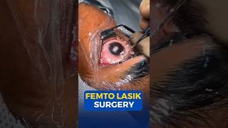 Femto Lasik Surgery [upl. by Ileane386]