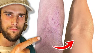 How I Cured My Eczema In Just 1 Week [upl. by Hessler]