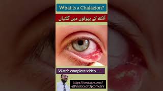 Chalazion  Meibomian Cyst  Eyelid Cyst  Practice Of Optometry  Eye Exam  Eye Lump  Eye Pain [upl. by Ttezil597]