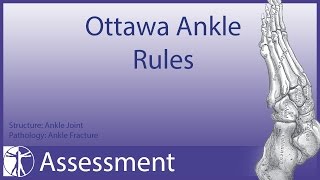 Ottawa Ankle Rules  Ankle Fracture [upl. by Ailene]