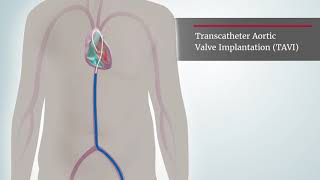 Aortic Stenosis  TAVI procedure [upl. by Tolmann]