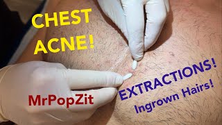 Chest congestionblackheads whiteheads ingrown hairs Multiple plugs extracted patient left happy [upl. by Sundstrom]