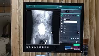 MCUG  micturating cystourethrogram procedure  mcug x ray  easy way to perform mcug x ray [upl. by Adnoyek]