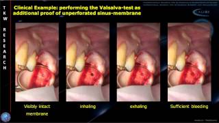 INTRALIFT Histology Study JOMS Audioslides [upl. by Balough553]