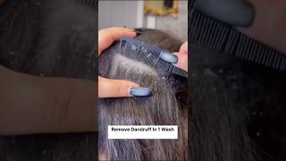 Easy Dandruff Removal Home Remedy Dandruff Free Hair Just 1 Wash 💫🌟hairgrowth hairfall shorts [upl. by Kinchen249]