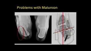 Calcaneal Malunion [upl. by Kacerek]