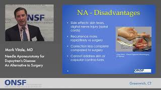 Needle Aponeurotomy An Alternative to Surgery for Dupuytrens Disease [upl. by Ardnael]