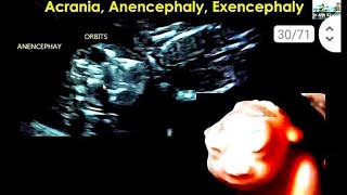 anencephaly 16 सप्ताह के बच्चे का हेडब्रेन brain 🧠 का नही बनना [upl. by Adlog309]