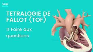 TETRALOGIE DE FALLOT TOF 11 Foire aux questions [upl. by Hinda]