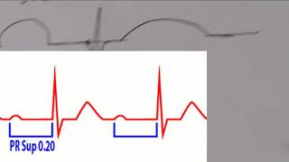 ECG Interpretation tres facile de l ECG 13eme partie Les troubles de conduction [upl. by Riobard]