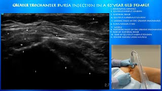 Ultrasound Guided Greater Trochanter Injection by probeultrasound [upl. by Domenic433]