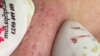 Effective Acne Scar Treatments for Smooth Skin Addressing Cystic Acne Fungal Acne and Hormonal Acn [upl. by Laamak23]