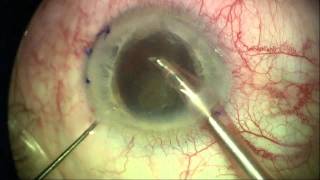 Cataract Surgery with a Limbal Relaxing Incision LRI to Correct Astigmatism [upl. by Happ127]