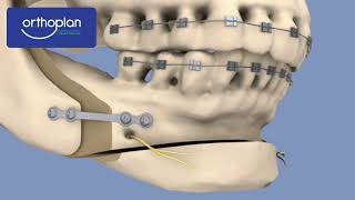 Orthoplan  Cirugia Maxilofacial [upl. by Lenaj179]