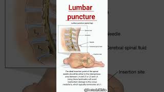 Lumbar puncture  viralshorts lumbarpuncture lumbarvertebrae vertebrae [upl. by Mccafferty]