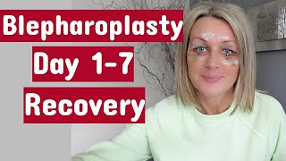 My Eye Surgery UpperampLower blepharoplasty  Day 17 Recovery [upl. by Trellas557]