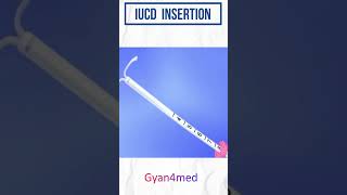 IUD insertion procedure in Hindi [upl. by Gonick]