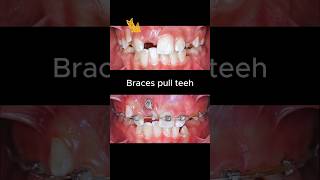 Braces for impacted tooth braces orthodontist dentist dentisty [upl. by Atkinson]