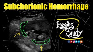 Subchorionic Hemorrhage  Ultrasound  Case 193 [upl. by Harraf]