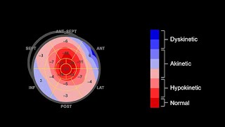 Interpreting the bulls eye plot in speckle tracking echocardiography [upl. by Yarahs]