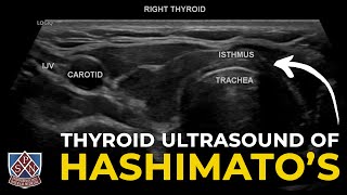 Thyroid Ultrasound of Hashimotos [upl. by Senecal552]