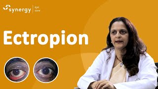 What Is Ectropion Ectropion Causes Symptoms and Treatment [upl. by Nnyliak]