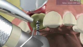 IMPLANTE DENTAL UNITARIO fase quirúrgica [upl. by Igor]