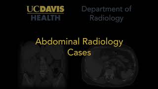 Hepatic steatosis MRI [upl. by Verada]