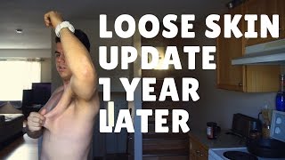 My Loose Skin Update  Tips on Preventing It amp Making it Better  FAQ Fridays [upl. by Innob]