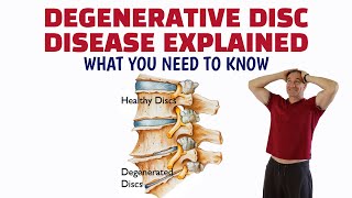 Degenerative Disc Disease Explained What You Need To Know [upl. by Zednanref]