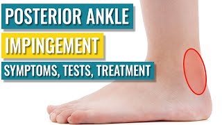 Posterior Ankle Impingement  Symptoms Diagnosis Treatment amp Recovery Time [upl. by Aima]