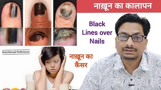 नाख़ून का कालापन  Black Lines on Nails  नाख़ून का कैंसर  Black Nails  Nail Cancer Melanoma nails [upl. by Einaej]