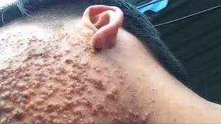 Big Cystic Acne Blackheads Extraction Blackheads amp Milia Whiteheads Removal Pimple Popping [upl. by Anala581]